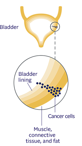 Padcev Enfortumab Vedotin Ejfv Advanced Bladder Cancer